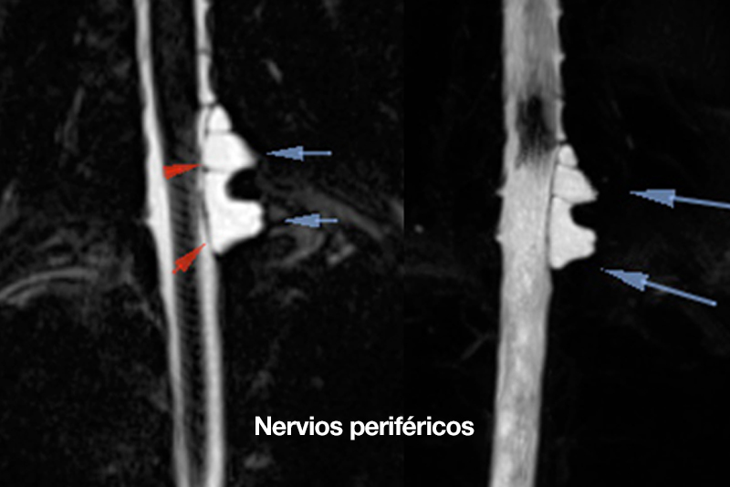 nervios periféricos