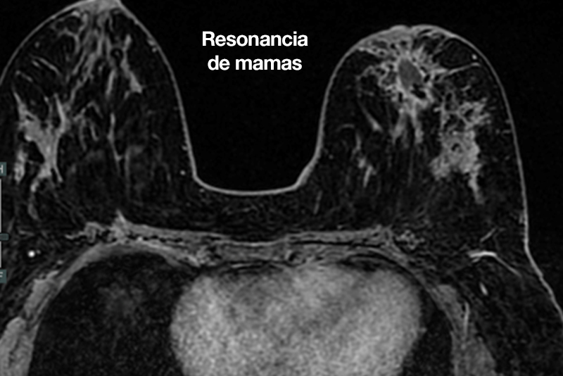 resonancia de mamas